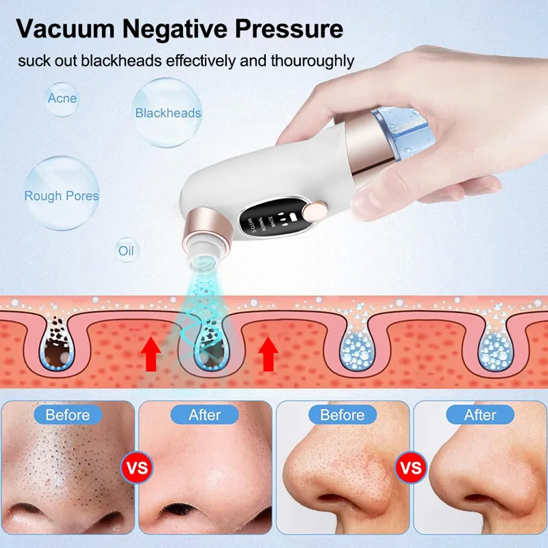 Extracteur de points noirs éle - Air Bubble Remover avis et prix